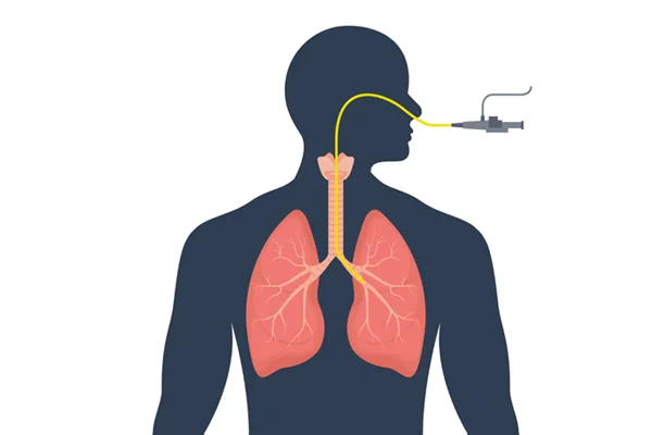 Bronchoscopy