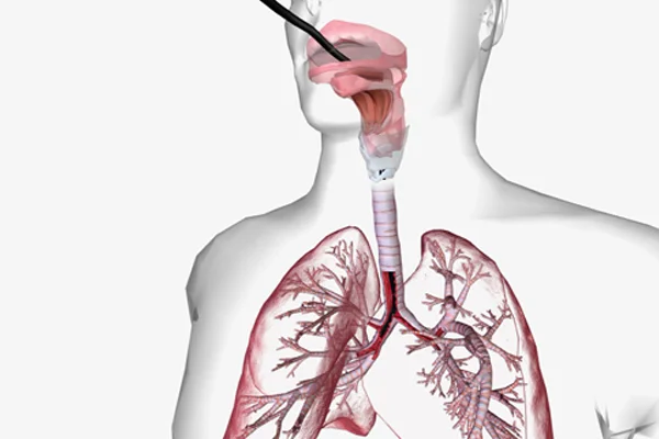 Lung Biopsy