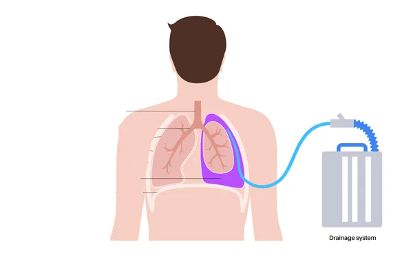 Chest Tube Insertion